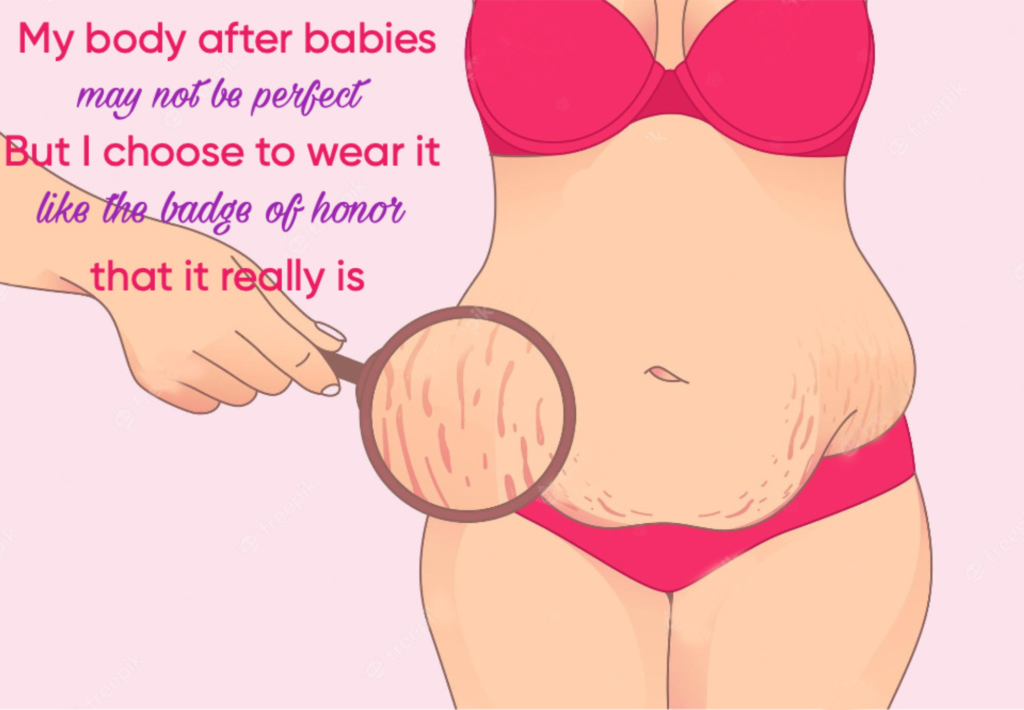 prevent stretch marks